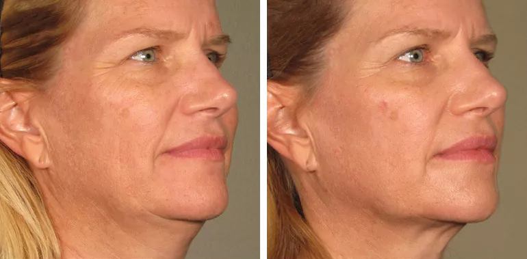 Do you need a LIFT? Let's talk about HIFU Face & Body