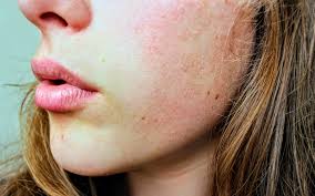 How to Tell if Your Skin’s Dehydrated (And What to Do About It)