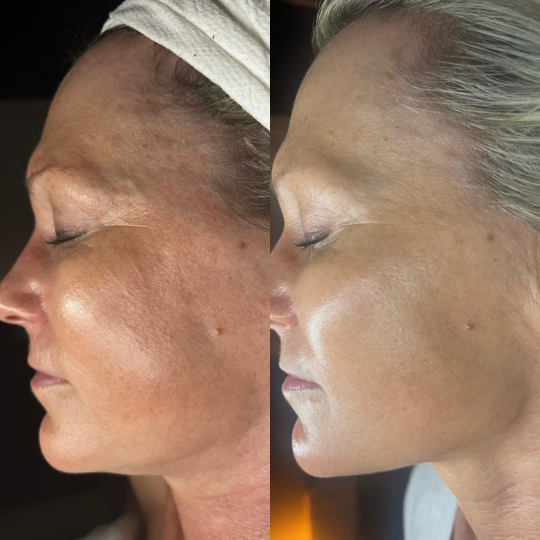 A before and after image series shows a woman's face demonstrating tighter, firmer skin after receiving Jet Plasma treatments.