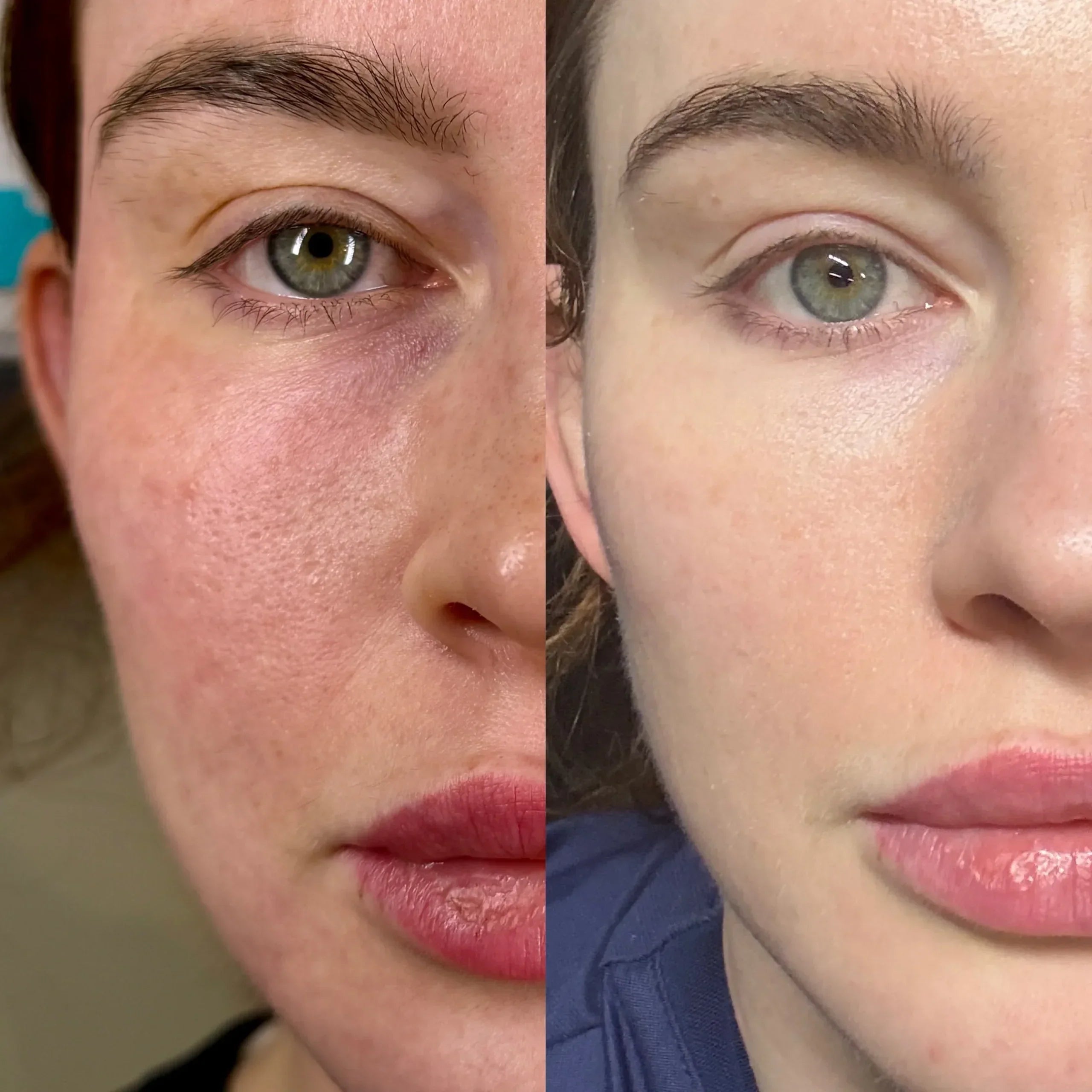 Transform Your Skin with Microneedling + PDGF
