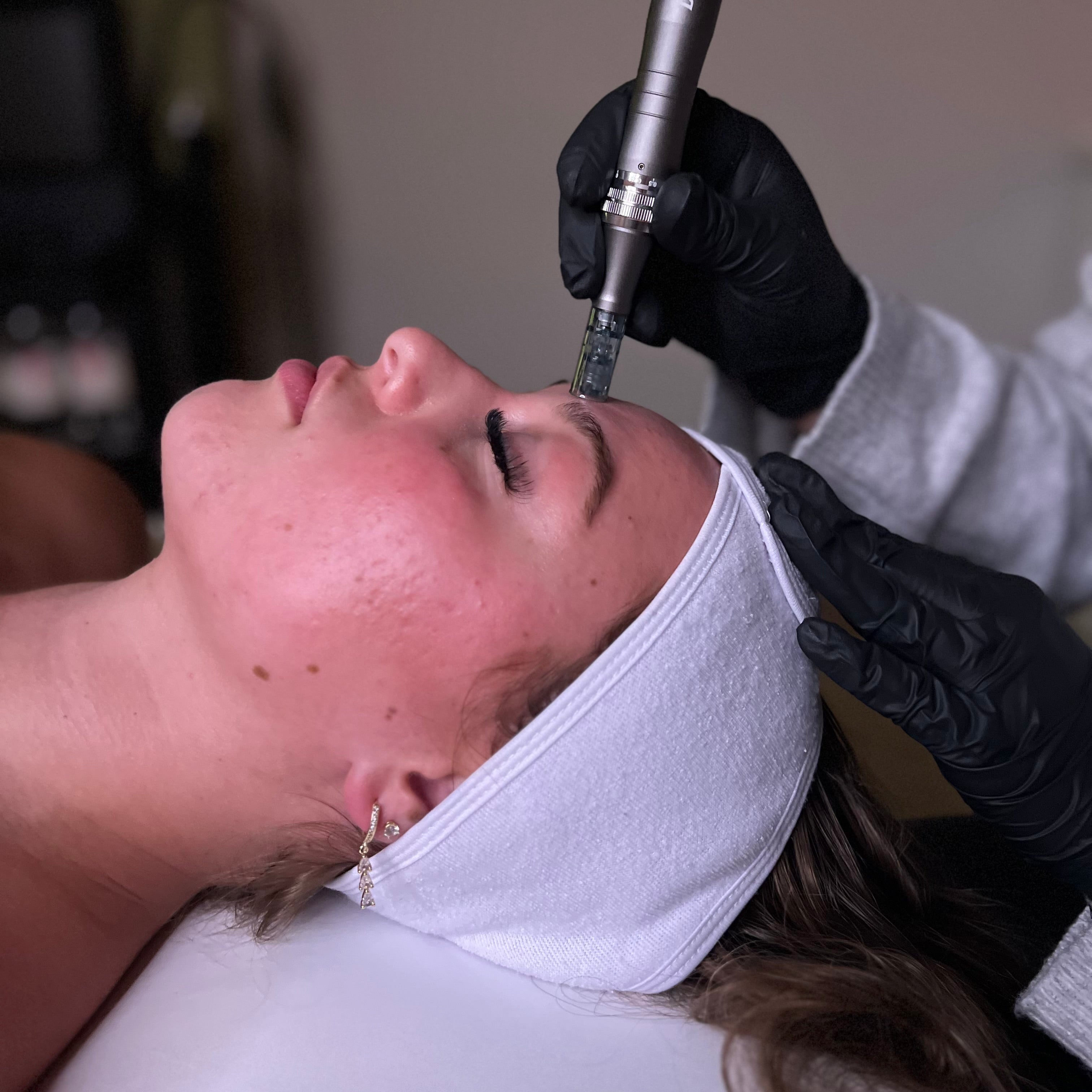 Transform Your Skin with Microneedling + PDGF