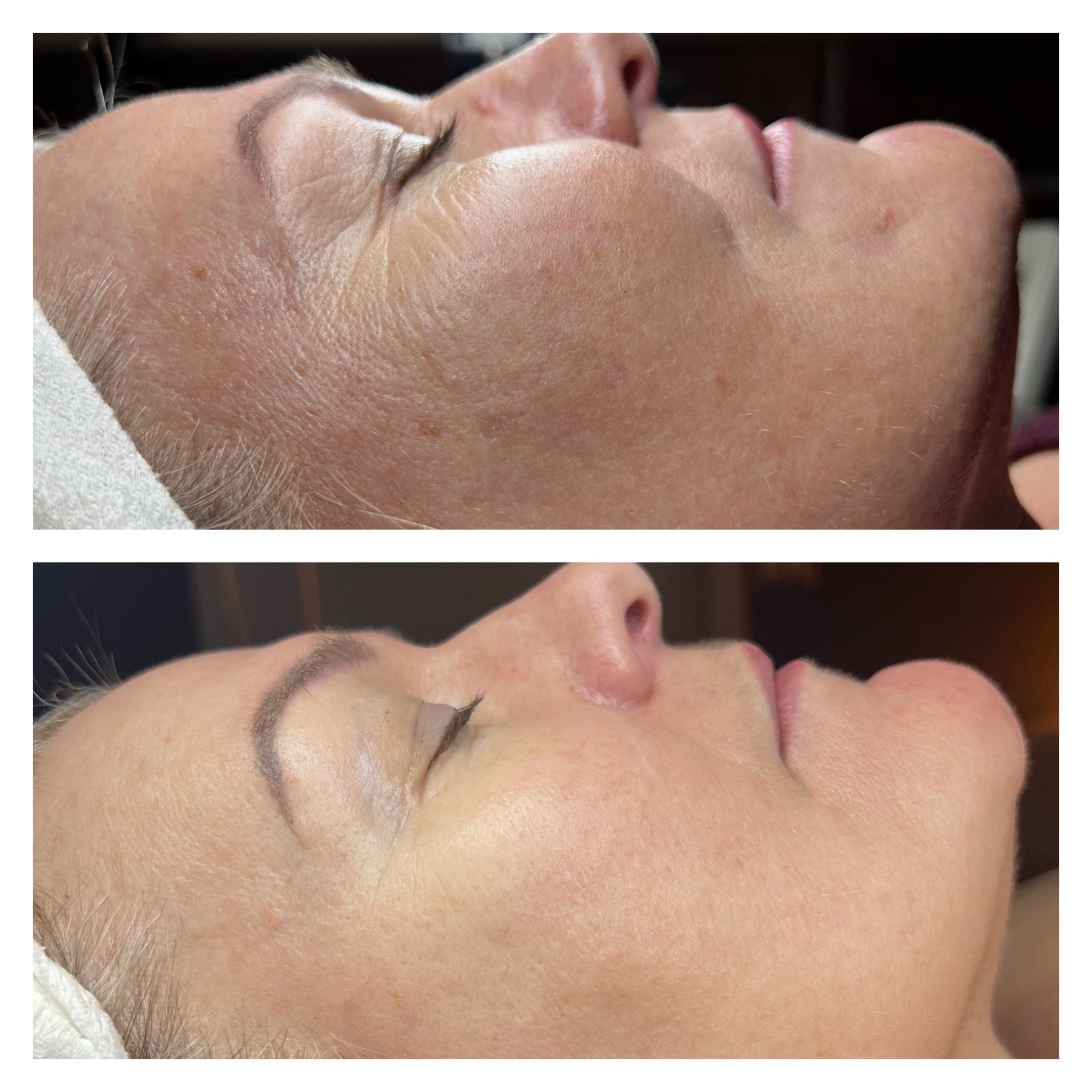 Game Changing Benefits of RF Microneedling for Flawless Skin
