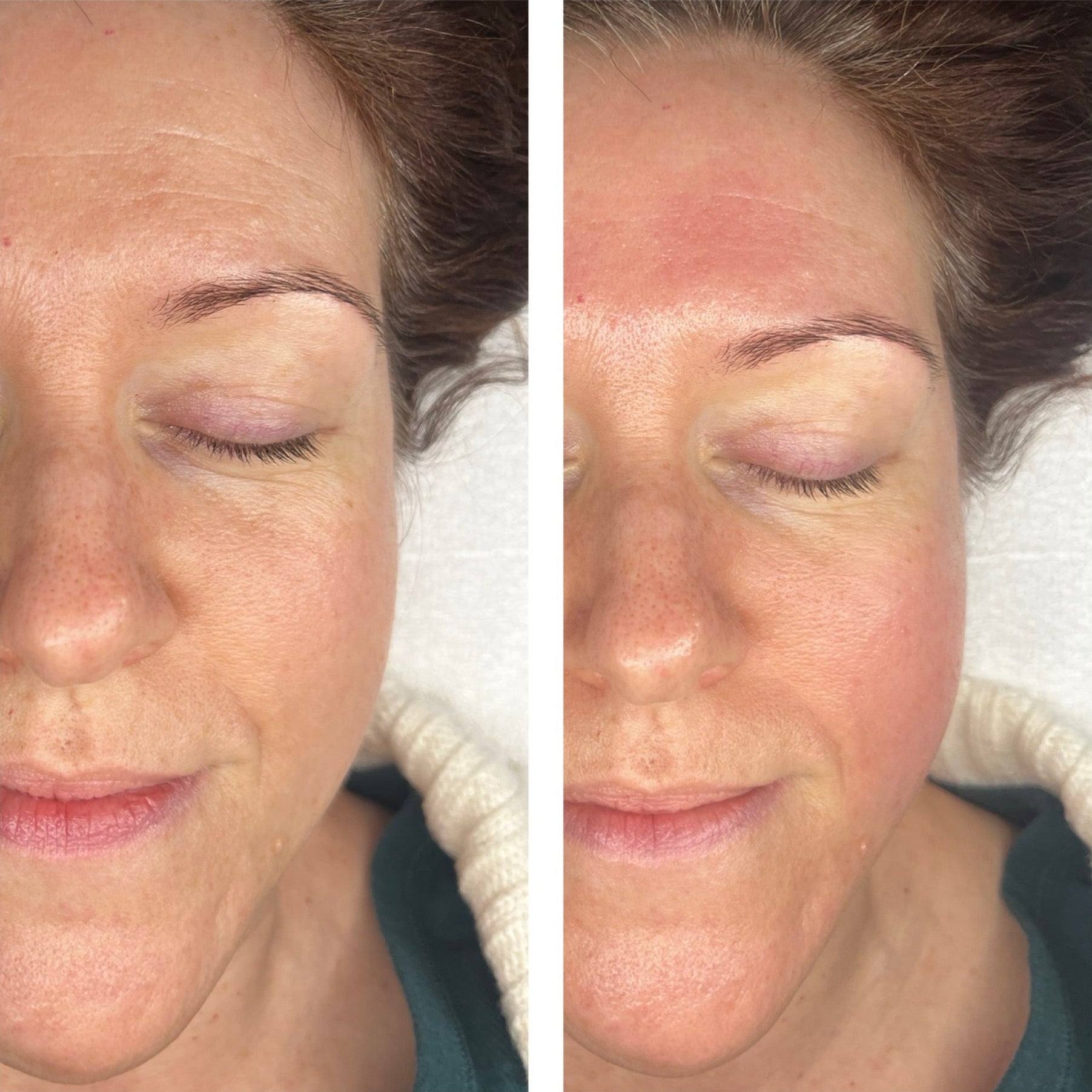 A before and after image series shows a woman's face demonstrating firmer skin after receiving giosculpt treatments.